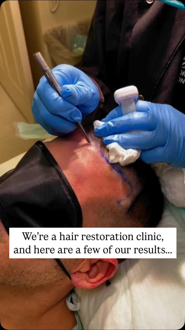 Real patients. Real results. Real growth. 

From FUE & FUT hair transplants to PRP therapy and prescription-based treatments, we offer customized solutions for every stage of hair loss.

At the Quatela Center, you’ll meet with our double board-certified facial plastic surgeons to create a personalized plan and determine the best options for you. This is hair restoration, done right.

#hairtransplantsurgery #hairtransplant #hairrestoration #hairsurgery #hairlosstreatment #prp
