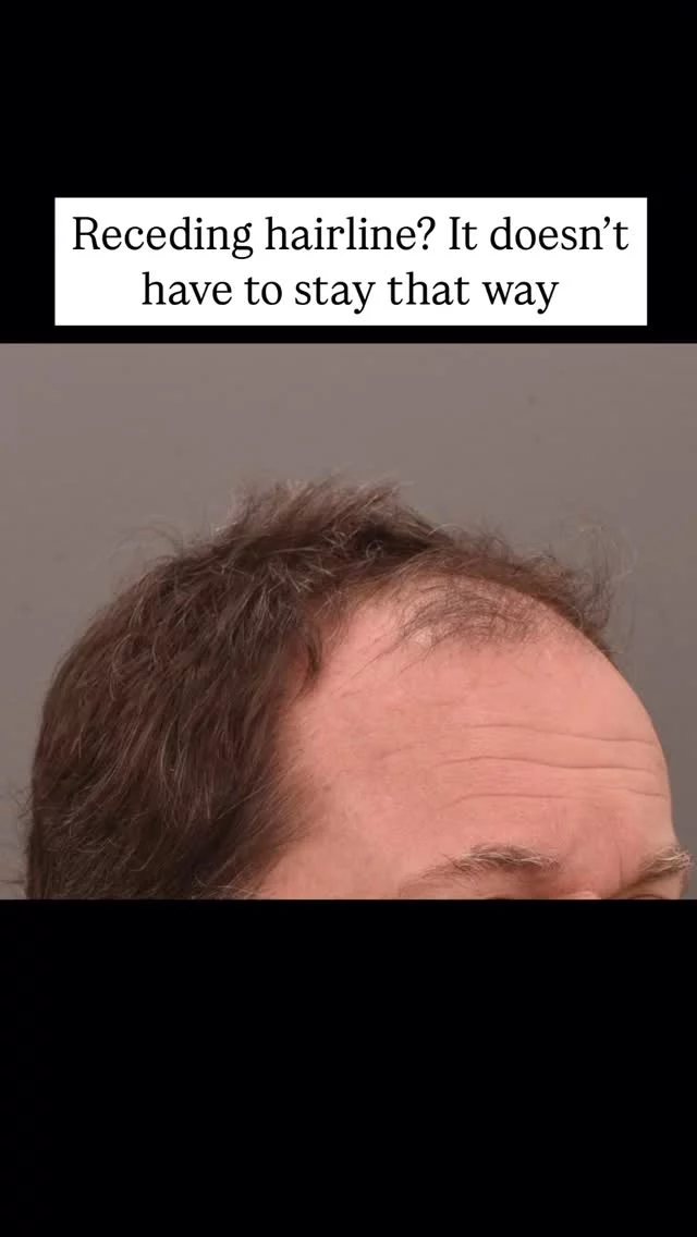 After 15 years of gradual hair loss, this patient came to us looking to restore and thicken his frontal hairline. One year post-hair transplant, the results show significant improvement in density and hairline definition.

Grafts: 2,500
Technique: FUT
Surgeon: World-Renowned, Double Board-Certified Facial Plastic Surgeon, Dr. Vito Quatela

#hairtransplantsurgery #hairtransplant #hairrestoration #hairsurgery #hairlosstreatment #hairtransplantation #hairsurgeon