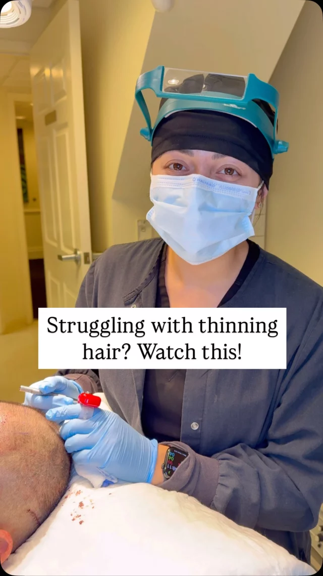 PSA: Thin hair doesn’t have to be forever.

With 2,200 grafts from front to crown, we’re restoring density across this patients entire scalp. Stacie, our certified trichologist, works closely with our surgical team to ensure each graft is placed with precision.

FUT can leave a small scar, but for those with longer hair and bigger restoration goals, it can be the perfect choice.

#hairtransplantsurgery #hairtransplant #hairlosstreatment #fut #futhairtransplants