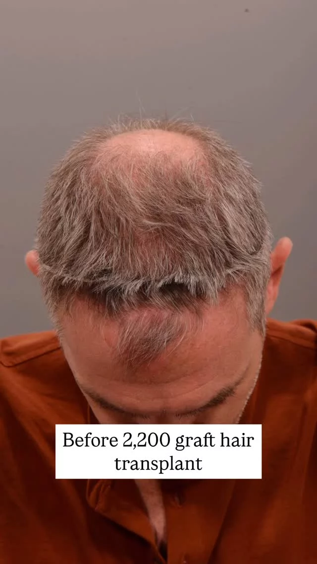 At the 6-month mark post-FUE hair transplant, we’re seeing amazing progress. 

This is the stage where new growth becomes visible and things really begin to take shape. But remember - this is still just part of the journey. Most patients won’t see their full results until around the 12-month mark.

If you’re considering a transplant, let this be proof that patience pays off! 

#hairtransplantsurgery #hairtransplant #hairlosstreatment #hairtransplantation #baldinghair #thinninghair #hairloss