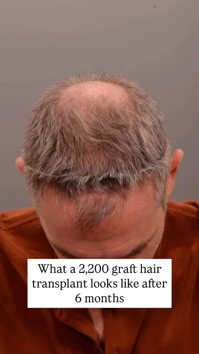 At the 6-month mark post-FUE hair transplant, we’re seeing amazing progress. 

This is the stage where new growth becomes visible and things really begin to take shape. But remember - this is still just part of the journey. Most patients won’t see their full results until around the 12-month mark.

If you’re considering a transplant, let this be proof that patience pays off! 

#hairtransplantsurgery #hairtransplant #hairlosstreatment #hairtransplantation #baldinghair #thinninghair #hairloss