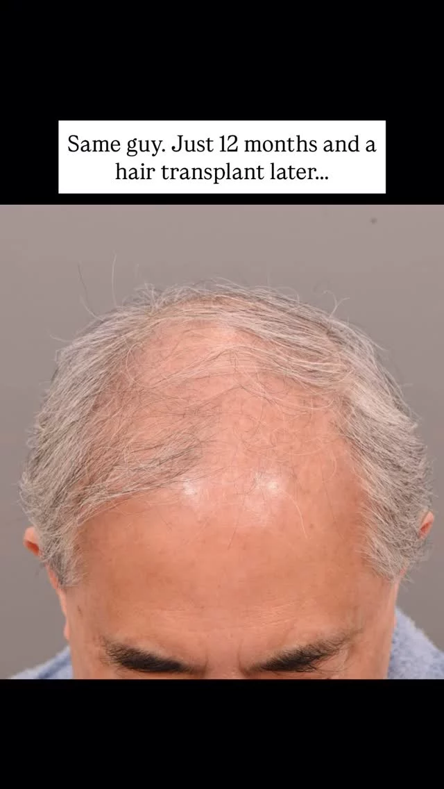 Hair loss is something a lot of guys face, and it’s never easy to deal with. This patient had been struggling for years before choosing an FUT hair transplant. We used 2,900 grafts to rebuild his hairline and add thickness - and wow, just look at the difference! 

He’s also using minoxidil and finasteride to keep his natural hair healthy and support the transplant results.

We’ve said it before, and we’ll say it again – it’s all about combining the right treatments for the best outcome. 

Surgeon: Dr. Vito Quatela 

#hairtransplantsurgery #minoxidil #finasteride #hairtransplant #hairrestoration #hairlosstreatment