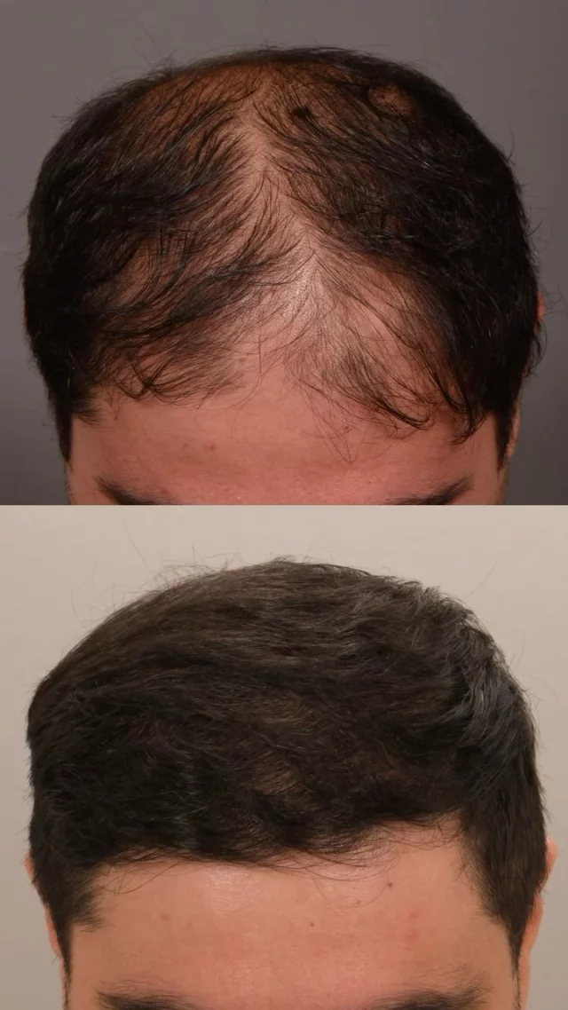 This patient came to us in 2022 with hair loss along his hairline and top of the scalp.

He had an FUT transplant with Dr. Quatela, where a small strip of scalp is removed to harvest grafts - a technique that delivers dense, natural-looking results with minimal scarring.

To enhance his results, he uses 82F daily, a prescription topical with minoxidil, finasteride, and other ingredients that help hair grow and prevent further loss.

That’s why we always stress a multimodality approach - combining treatments is key to achieving the best, longest-lasting results!

# of grafts transplanted: 2,600

#hairtransplantsurgery #futhairtransplants #hairsurgery #finasteride #minoxidil #thinninghair #hairsurgeon