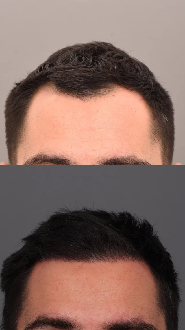 27 years old. 2,000 grafts. 5 months post-FUE transplant. 🔥

Temple recession is one of the most common concerns we treat, and this case is a perfect example of the natural results achievable with FUE combined with medical therapy. What makes this even more impressive is that we’re only about halfway through the process – final results typically come in around 12 months.

He’s also taking oral minoxidil to support both transplanted and existing hair, allowing for the best outcome.

Surgeon: @dralexmontague 

Ready for your own transformation? Book your consultation today!

#hairtransplant #FUEtransplant #hairrestoration #templehair #beforeandafter #oralminoxidil #hairlinerestoration #naturalresults
