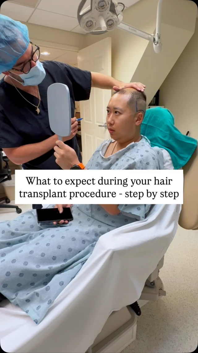 What to expect during your hair transplant procedure – from designing your new hairline to the moment you walk out. 

Once your hairline is designed or your treatment plan is set – we’ll begin extracting and placing grafts. All you have to do is sit back and relax. Bring your headphones, watch a movie, listen to music, or even take a nap.

The procedure can take several hours depending on the number of grafts being transplanted, but we numb the recipient site with a local anesthetic – so you shouldn’t feel any pain or discomfort.

Once it’s done, the most important part begins: healing. You’ll start to see noticeable growth around the 6-month mark, with full results by one year. Patience is key!

#hairtransplantsurgery #hairtransplant #hairrestoration #hairlosstreatment #hairsurgery