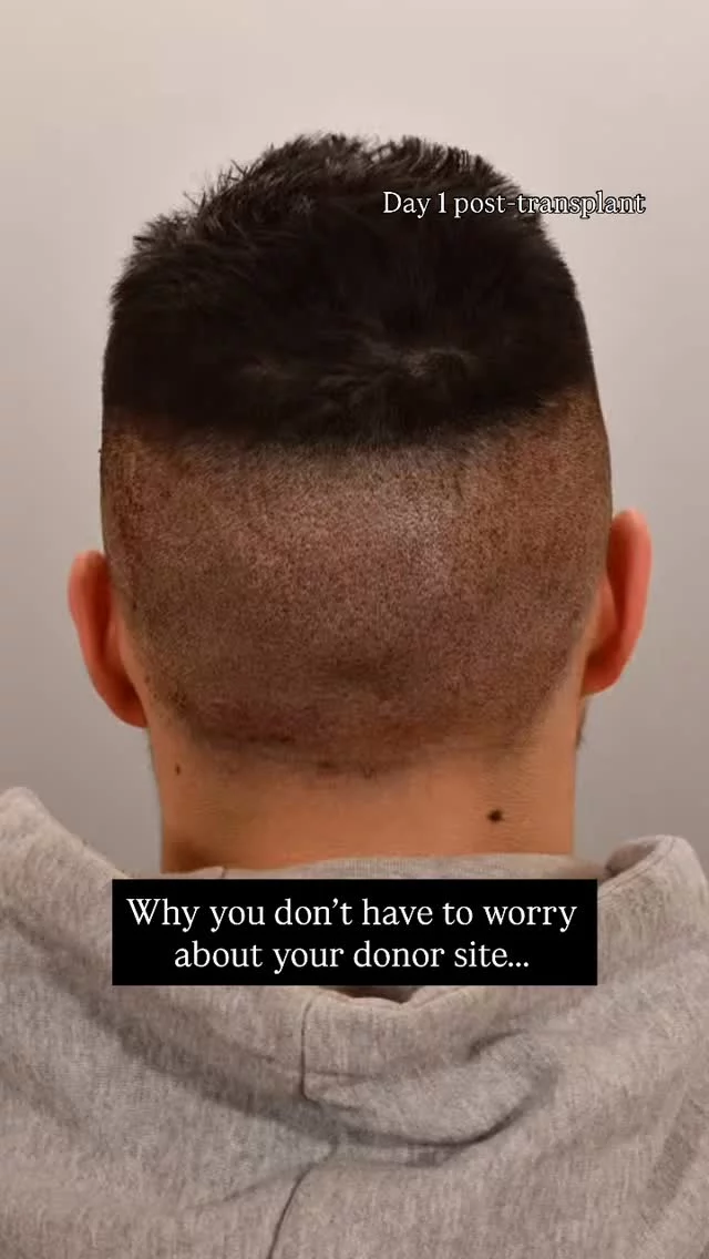 Your donor site heals WAY faster than you think after an FUE transplant!

✅ Day 1: Tiny extraction sites where follicles were removed
✅ Day 14: Fully healed, no visible scarring

You’re back to the gym, work, and social life in no time. No one will even notice!