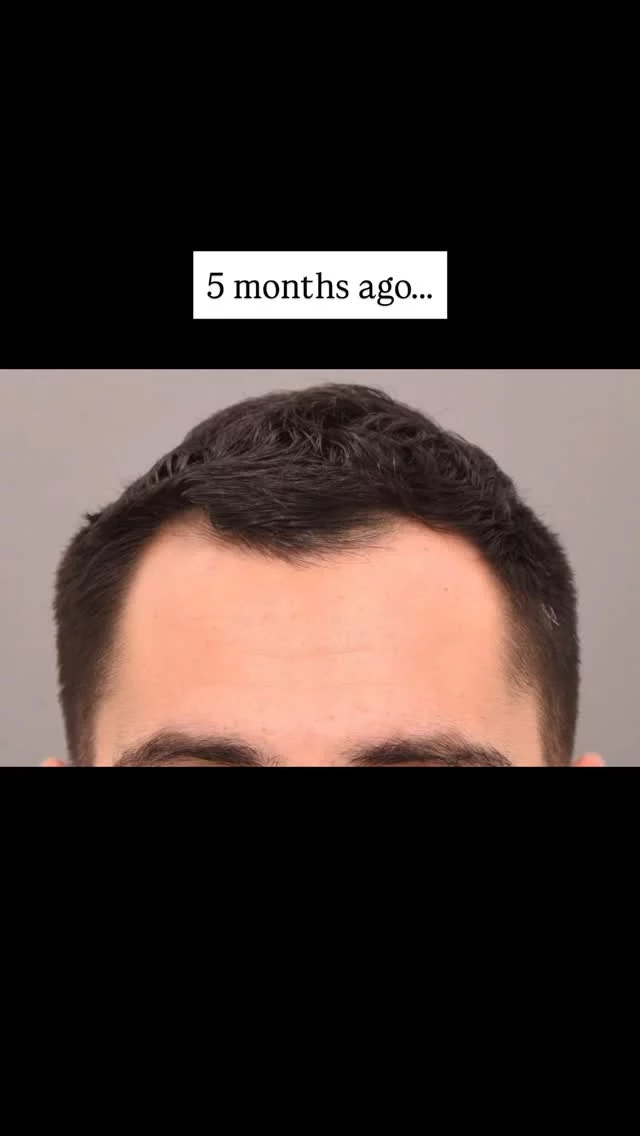 27 years old. 2,200 grafts. 5 months post-FUE transplant. 🔥

Temple recession is one of the most common concerns we treat, and this case is a perfect example of the natural results achievable with FUE combined with medical therapy. What makes this even more impressive is that we’re only about halfway through the process – final results typically come in around 12 months.

He’s also taking oral minoxidil to support both transplanted and existing hair, allowing for the best outcome.

Ready for your own transformation? Book your consultation today!

#hairtransplant #FUEtransplant #hairrestoration #templehair #beforeandafter #oralminoxidil #hairlinerestoration #naturalresults #confidence #bookconsultation