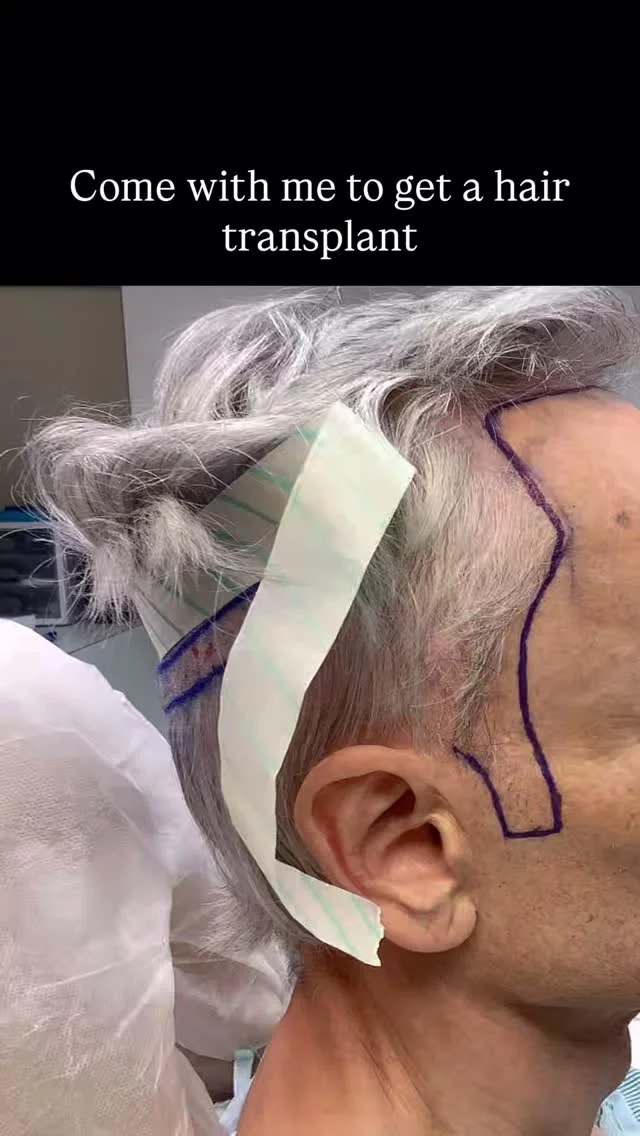 1,900 graft hair transplant!

For this patient we focused on filling in his hairline and getting those sideburns back to full coverage. He wanted a more defined hairline and better facial framing overall.

Results start showing around 6 months, with the full transformation at 1 year.

#hairtransplantsurgery #fut #hairtransplant #hairrestoration #thinninghair