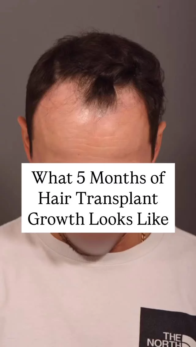 Check out this incredible transformation! Just 5 months after his hair transplant with Dr. Vito Quatela, this patient is already seeing HUGE results! And the best part? Full results are still on the way in the next year!

Technique: FUE
Grafts: 1,600

#hairsurgeon #hairtransplantation #hairlosstreatment #hairrestoration #hairtransplant #fue #fuehairtransplant #follicularunitextraction