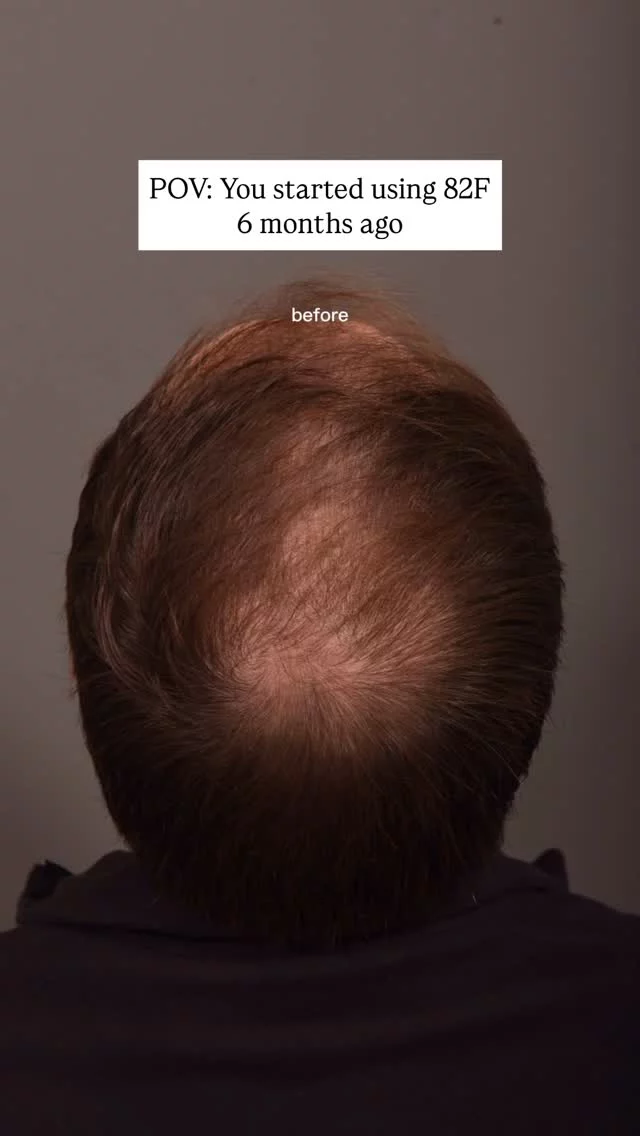 Why we recommend 82F for thinning: it combines two proven ingredients (minoxidil + finasteride) in one treatment, and we typically see very robust results in the crown area! This client’s 6-month transformation is the perfect example. 

What makes 82F special is that it targets the problem with a dual approach - stimulating growth while blocking the hormones that cause hair loss. The key is daily consistency - hair growth is a gradual process, but the wait is absolutely worth it!

#hairlosstreatment #hairloss #thinninghair #baldinghair #82F #minoxidil #finasteride