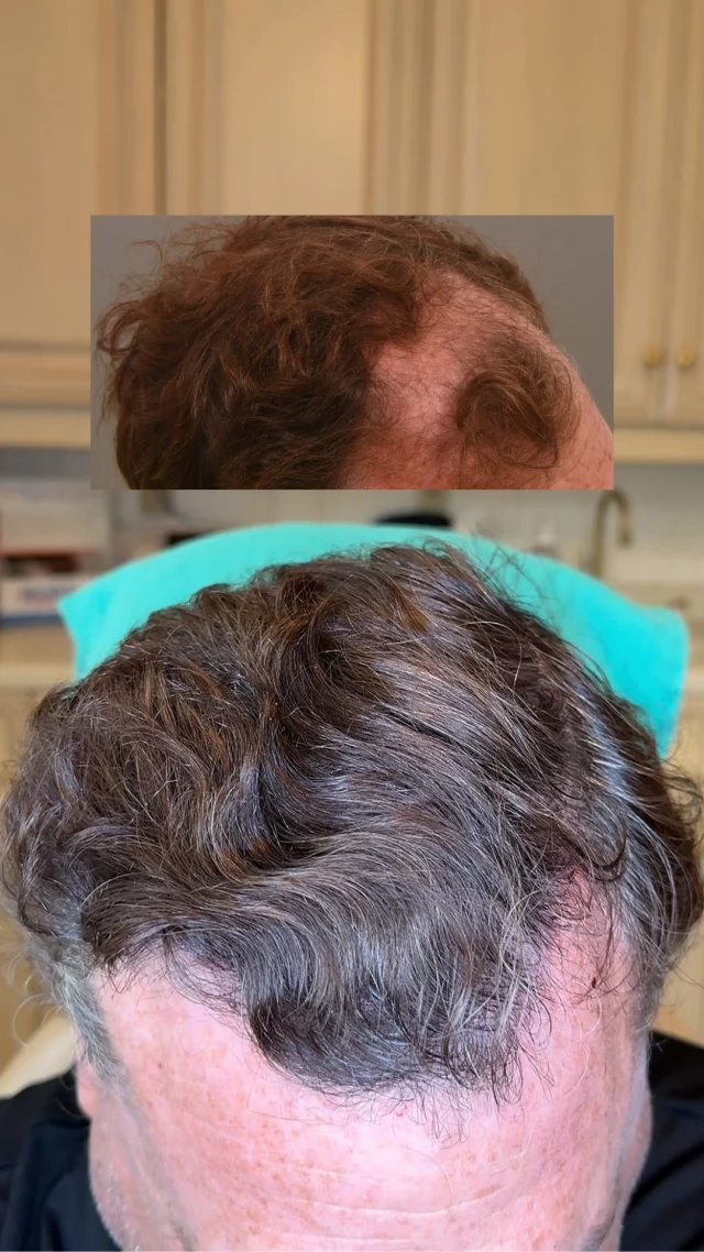 This is what happens when you commit to the process.

This patient didn’t just hope for results – he followed through: 

🧴 Using 82F prescription topical (daily) 
💉 Regular PRP maintenance treatments 
🧑‍⚕️ 2 years post first FUT with Dr. Quatela - 3,200 grafts to restore the hairline + top of head 
🔁 1 year post second FUT - 2,000 grafts to fill in the crown

Multimodal hair restoration works – when it’s done right, and done consistently.

#hairtransplantsurgery #hairtransplant #hairrestoration #hairlosstreatment #prp #finasteride #minoxidil