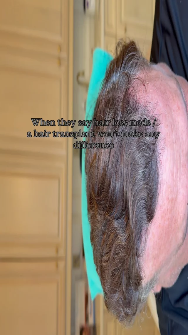 This is what happens when you commit to the process.

This patient didn’t just hope for results – he followed through: 

🧴 Using 82F prescription topical (daily) 
💉 Regular PRP maintenance treatments 
🧑‍⚕️ 2 years post first FUT with Dr. Quatela - 3,200 grafts to restore the hairline + top of head 
🔁 1 year post second FUT - 2,000 grafts to fill in the crown

Multimodal hair restoration works – when it’s done right, and done consistently.

#hairtransplantsurgery #hairtransplant #hairrestoration #hairlosstreatment #prp #finasteride #minoxidil
