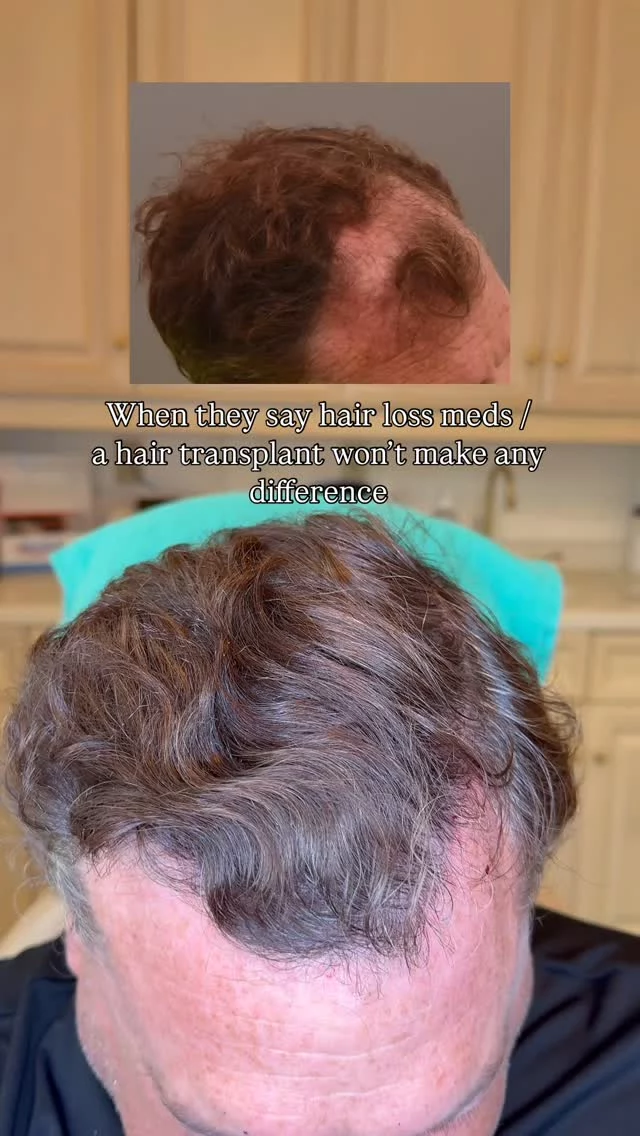 This is what happens when you commit to the process.

This patient didn’t just hope for results – he followed through: 

🧴 Using 82F prescription topical (daily) 
💉 Regular PRP maintenance treatments 
🧑‍⚕️ 2 years post first FUT with Dr. Quatela - 3,200 grafts to restore the hairline + top of head 
🔁 1 year post second FUT - 2,000 grafts to fill in the crown

Multimodal hair restoration works – when it’s done right, and done consistently.

#hairtransplantsurgery #hairtransplant #hairrestoration #hairlosstreatment #prp #finasteride #minoxidil