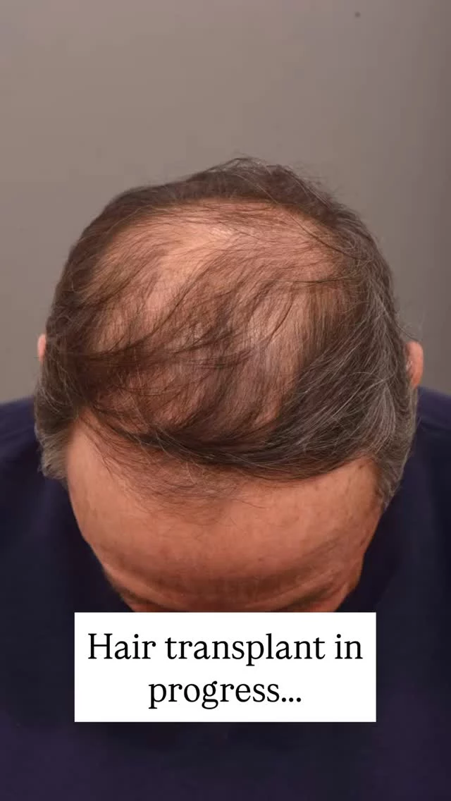 Dealing with hair loss? This procedure could change your life!

1800 grafts transplanted. FUE technique, no scars – a total game-changer. 

Noticeable results in 6 months, full results at one year! 

Surgeon: World-Renowned, Double Board-Certified Facial Plastic Surgeon, Dr. Vito Quatela 

#hairtransplantsurgery #hairtransplant #hairsurgery #hairlosstreatment #thinninghair #baldinghair