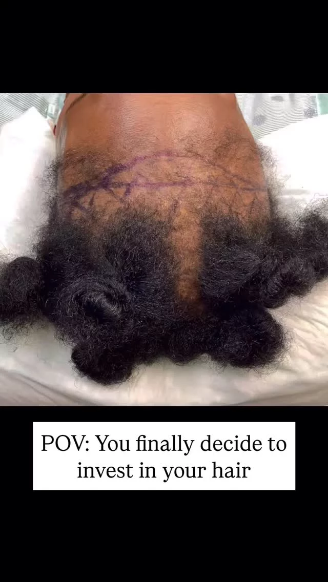 Many people with curly or textured hair wonder if they’re candidates for hair transplants. The answer is absolutely YES!

Curly hair actually has some advantages: 
- Provides excellent coverage 
- Natural texture camouflages transplant sites beautifully 

We restored her frontal hairline using 1,500 grafts and the FUT method - look at that incredible new growth!

#hairtransplantsurgery #fut #femalehairtransplant #hairrestoration