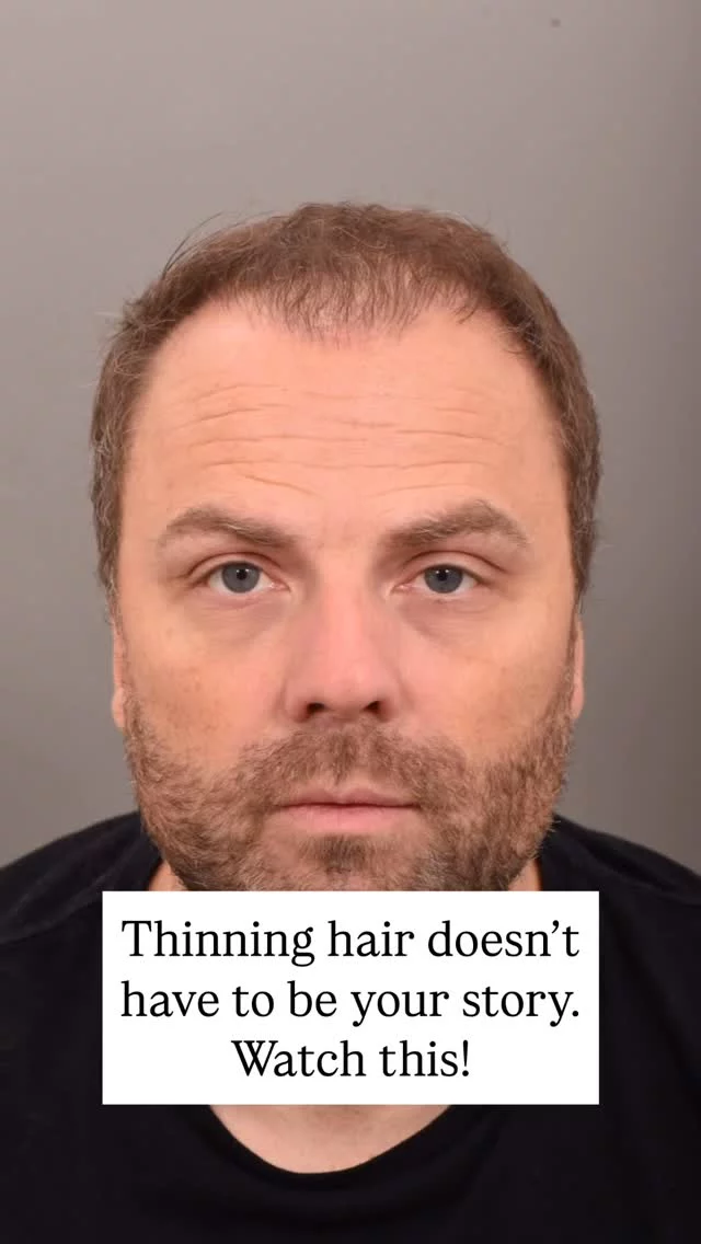 1 year after a 1,900 graft FUE hair transplant with Dr. Quatela - and the results are next-level!

FUE is a minimally invasive technique that leaves no linear scar, making it a great option for those who prefer to wear their hair shorter.

Thinking about hair restoration? Now’s the time.

#hairtransplantsurgery #hairtransplant #hairrestoration #hairsurgery #hairtransplantation