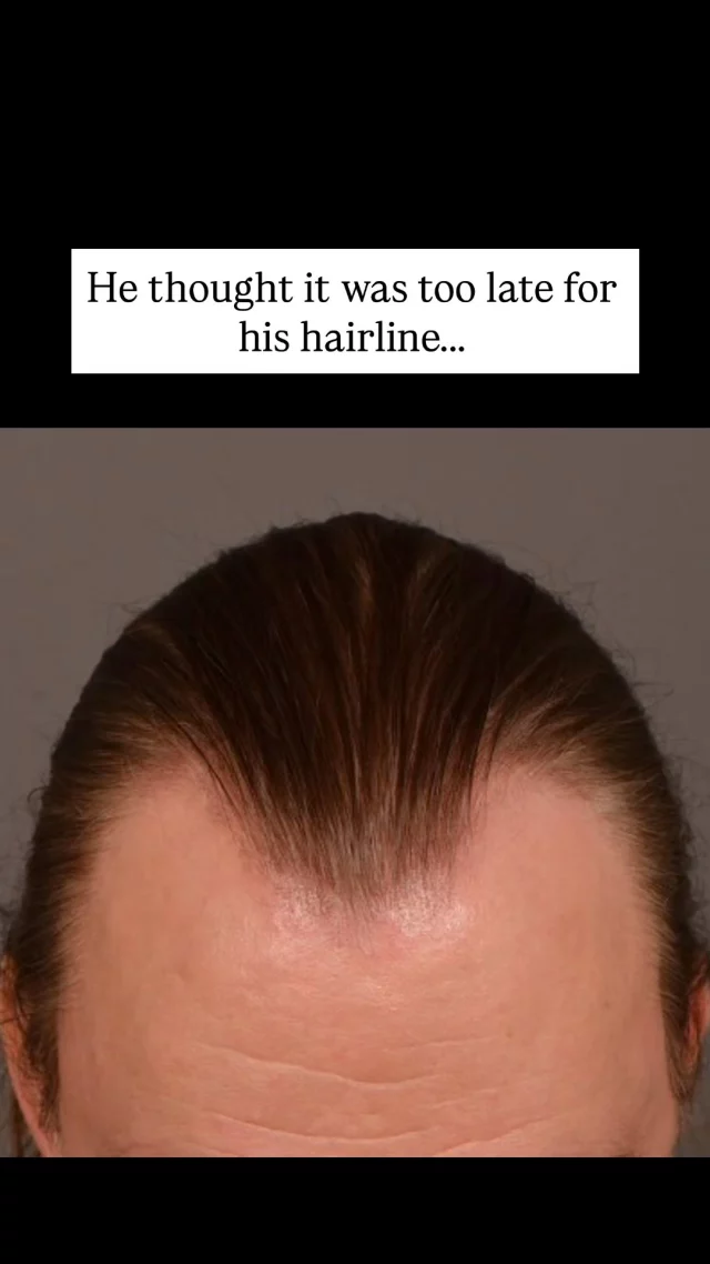 This patient came to us concerned with frontal hairline and temple recession. Now 5 months after his FUT procedure, his temples are already showing incredible progress! 

✨ What you’re seeing: Early results that will continue to dramatically improve over the next 7 months as we approach the 1-year mark - when full results are typically achieved.

At 5 months: New hair is emerging and density is noticeably improving. Hair is still finer than natural hair and some patchiness is normal as follicles grow at different rates. Both donor and recipient areas are well-healed. Remember - full results take up to a year, so patience is key!

Grafts: 3075
Surgeon: Dr. Vito Quatela

#hairtransplantsurgery #hairtransplant #hairlosstreatment #hairtransplantation #templerecession