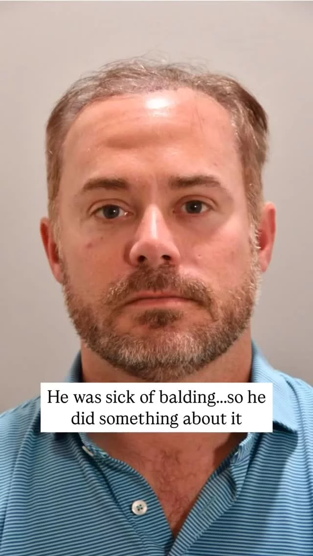 Ever wonder what a hair transplant + PRP can really do? Check this out!

After 2 years of thinning at the hairline, this patient’s FUT transplant + maintenance PRP treatments gave him a full, thick hairline and a serious confidence boost.

Over a year later, the results speak for themselves!

Grafts: 1,900
Surgeon: World-Renowned, Double Board-Certified Facial Plastic Surgeon, Dr. Vito Quatela

#hairtransplantsurgery #hairtransplant #prp #prptreatment #hairlosstreatment #hairrestoration