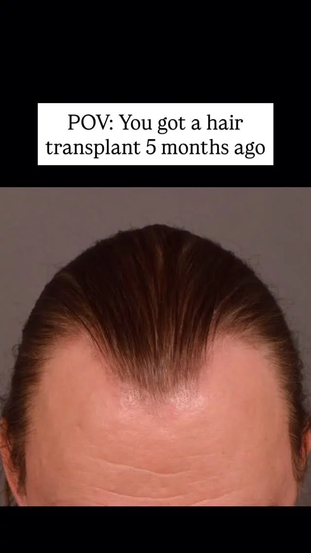 This patient came to us concerned with frontal hairline and temple recession. Now 5 months after his FUT procedure, his temples are already showing incredible progress! 
✨ What you’re seeing: Early results that will continue to dramatically improve over the next 7 months as we approach the 1-year mark - when full results are typically achieved.

At 5 months: New hair is emerging and density is noticeably improving. Hair is still finer than natural hair and some patchiness is normal as follicles grow at different rates. Both donor and recipient areas are well-healed. Remember - full results take up to a year, so patience is key!

Grafts: 3075
Surgeon: Dr. Vito Quatela

#hairtransplantsurgery #hairtransplant #hairlosstreatment #hairtransplantation #templerecession