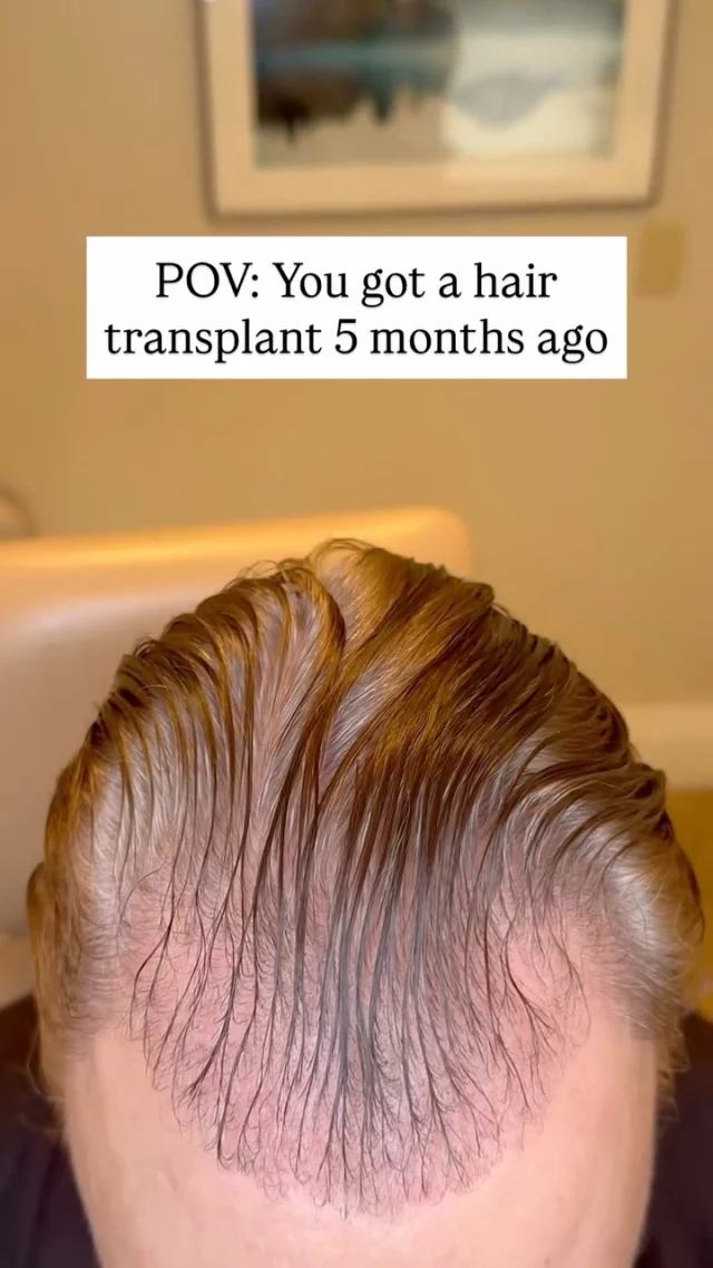 This patient came to us concerned with frontal hairline and temple recession. Now 5 months after his FUT procedure, his temples are already showing incredible progress! 

✨ What you’re seeing: Early results that will continue to improve over the next 7 months as we approach the 1-year mark - when full results are typically achieved.

At 5 months: New hair is emerging and density is improving. Hair is still finer than natural hair and some patchiness is normal as follicles grow at different rates. Both donor and recipient areas are well-healed. Remember - full results take up to a year, so patience is key!

Grafts: 3075
Surgeon: Dr. Vito Quatela

#hairtransplantsurgery #hairtransplant #hairrestoration #hairtransplantation #hairloss #hairsurgery