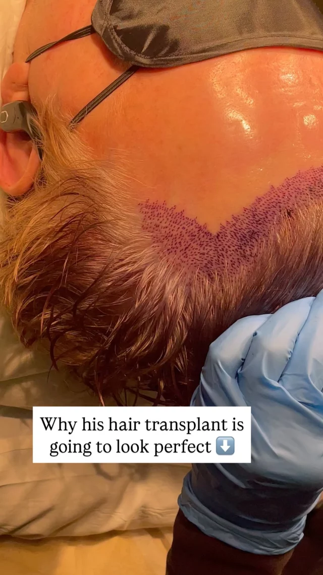 The planning stage is everything. Here, we’ve just finished mapping out exactly where each graft will go to create those micro irregularities and that naturally feathered hairline. This is where the true artistry happens in hair transplant surgery - getting every detail right so your new hairline looks like you were born with it.

#hairtransplant #hairtransplantsurgery #recedinghairline #hairloss #hairlosssolution #microirregularities #naturallyfeathered #trueartistry