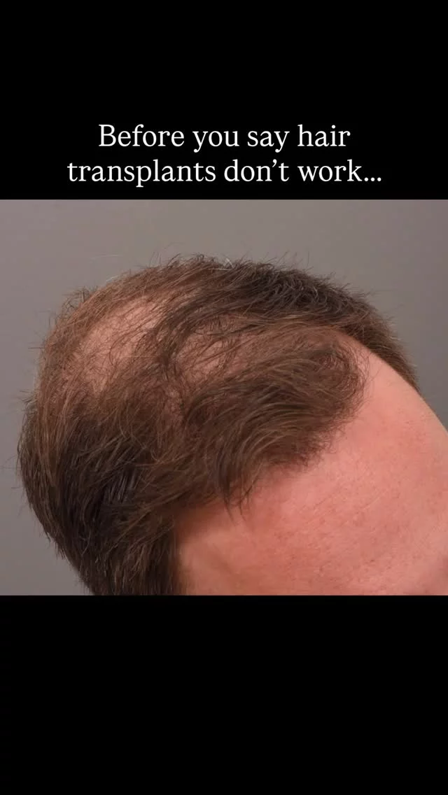 2+ years post-FUT hair transplant! 🔥 

2,300 grafts + daily 82F topical = these incredible results.

Surgeon: World Renowned Double Board-Certified Facial Plastic Surgeon, Dr. Vito Quatela