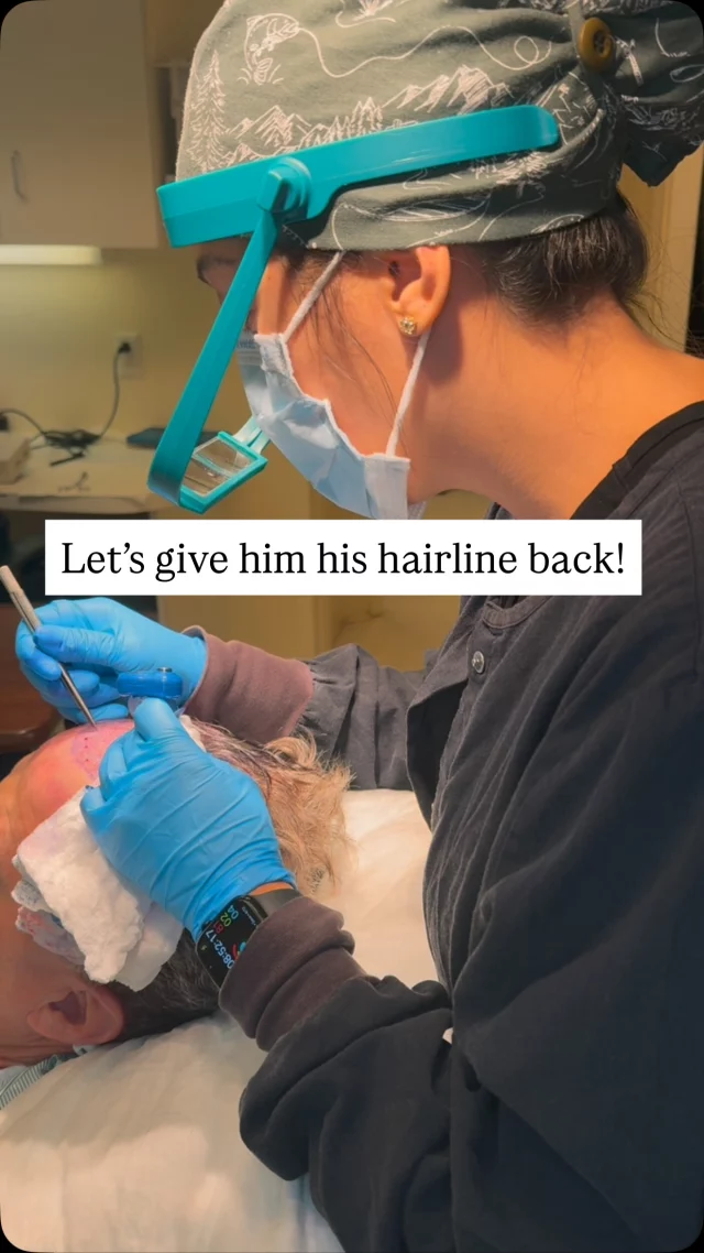 This patient started losing his hair at 17, and the gradual thinning continued into his 30s.

He had lived with it long enough and decided it was time to do something about it. We used 2500 grafts to rebuild the hairline he hadn’t seen in decades.

You won’t see the final result in this video because that takes time. Early growth usually begins around month 6, with full results coming in at the 1-year mark.

If you’re going through something similar, know there are options. Give us a call to schedule a consultation and find out what could work for you.

Surgeon: @drheatherlee 

#hairtransplantsurgery #hairtransplant #hairsurgery #2500grafts #fut