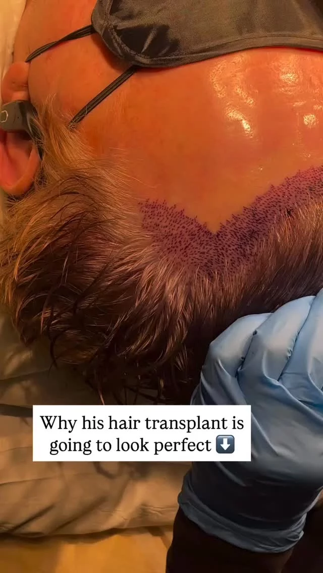 The planning stage is everything. Here, we’ve just finished mapping out exactly where each graft will go to create those micro irregularities and that naturally feathered hairline. This is where the true artistry happens in hair transplant surgery - getting every detail right so your new hairline looks like you were born with it.

#hairtransplant #hairtransplantsurgery #recedinghairline #hairloss #hairlosssolution #microirregularities #naturallyfeathered #trueartistry
