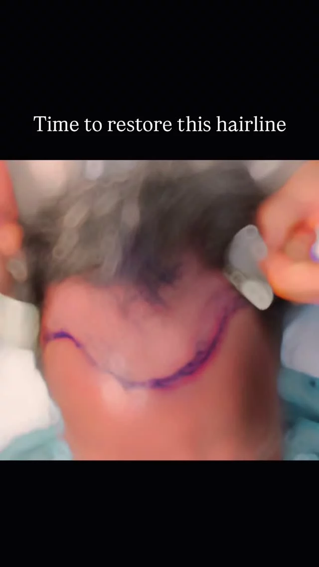 This patient started losing his hair at 17, and the gradual thinning continued into his 30s.

He had lived with it long enough and decided it was time to do something about it. We used 2500 grafts to rebuild the hairline he hadn’t seen in decades.

You won’t see the final result in this video because that takes time. Early growth usually begins around month 6, with full results coming in at the 1-year mark.

If you’re going through something similar, know there are options. Give us a call to schedule a consultation and find out what could work for you.

#hairtransplantsurgery #hairtransplant #hairsurgery #2500grafts #fut