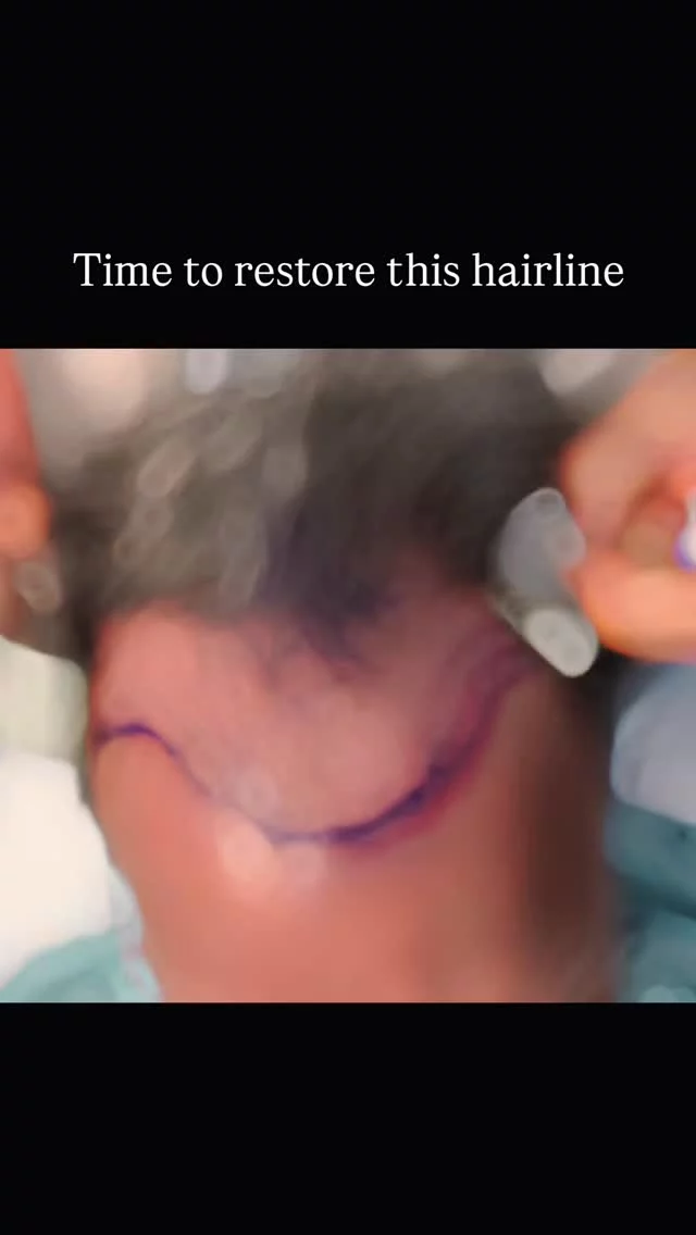 This patient started losing his hair at 17, and the gradual thinning continued into his 30s.

He had lived with it long enough and decided it was time to do something about it. We used 2500 grafts to rebuild the hairline he hadn’t seen in decades.

You won’t see the final result in this video because that takes time. Early growth usually begins around month 6, with full results coming in at the 1-year mark.

If you’re going through something similar, know there are options. Give us a call to schedule a consultation and find out what could work for you.

Surgeon: @drheatherlee 

#hairtransplantsurgery #hairtransplant #hairsurgery #2500grafts #fut