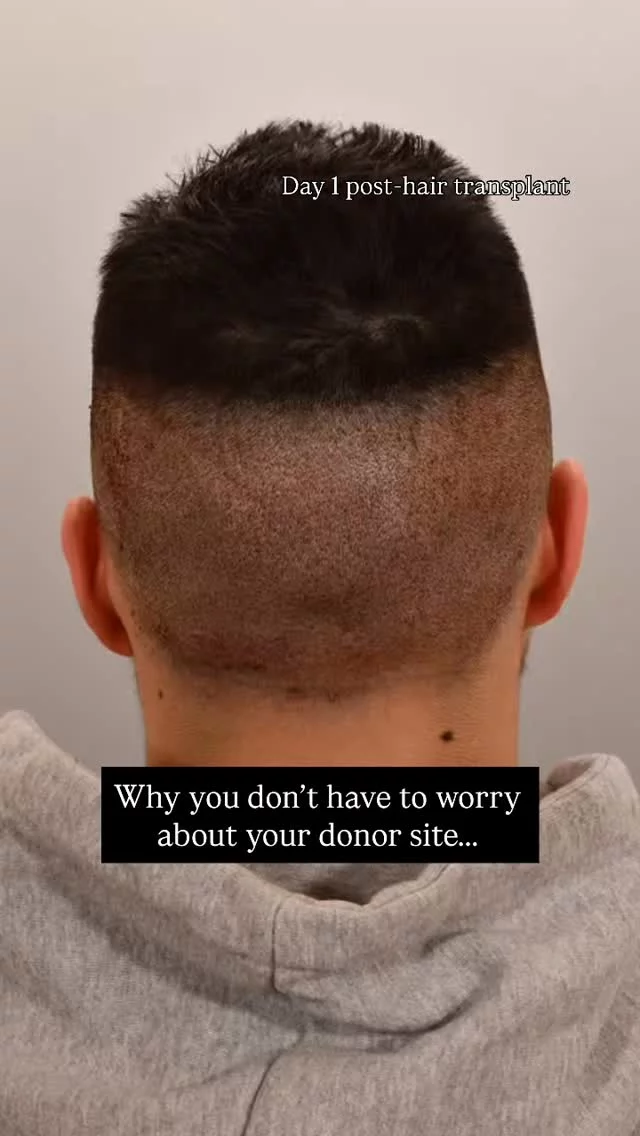 Your donor site heals WAY faster than you think after an FUE transplant!

✅ Day 1: Tiny extraction sites where follicles were removed
✅ Day 14: Fully healed, no visible scarring

You’re back to the gym, work, and social life in no time. No one will even notice!

#hairtransplantsurgery #fue #fuehairtransplant #hairsurgery #hairtransplantation #baldinghair