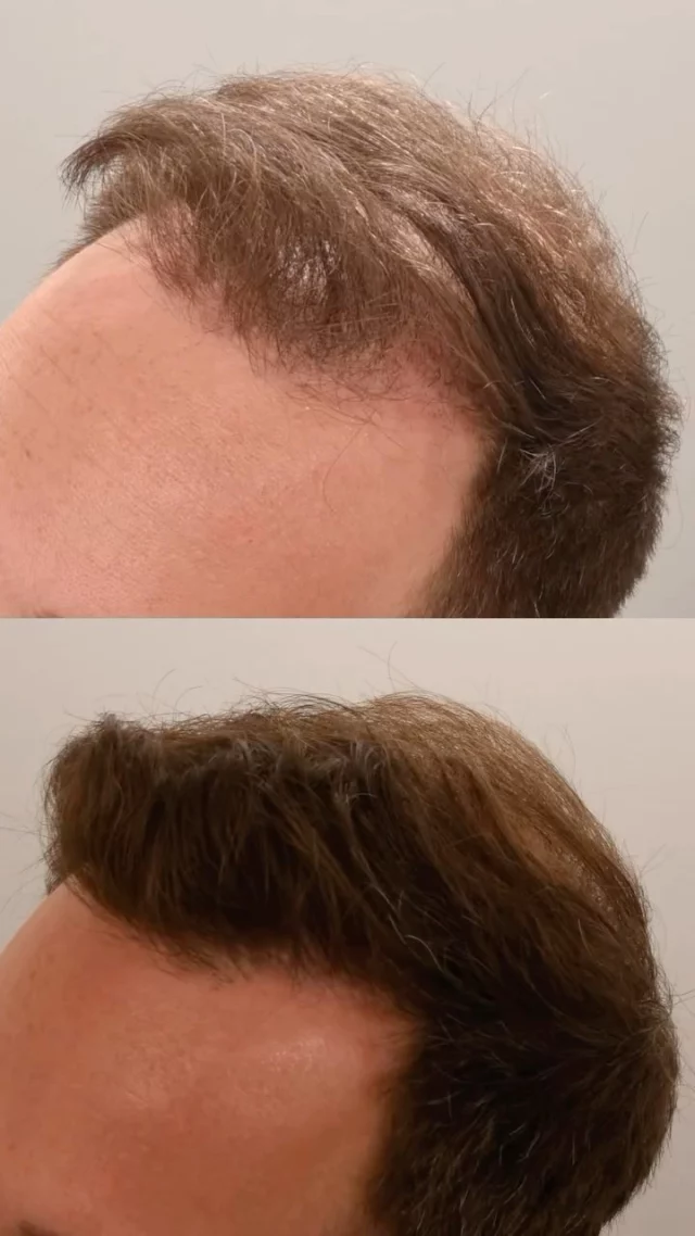2+ years post-FUT hair transplant! 🔥 

2,300 grafts + daily 82F topical = these incredible results.

Surgeon: World Renowned Double Board-Certified Facial Plastic Surgeon, Dr. Vito Quatela 

#thinninghair #hairloss #baldinghair #hairlosstreatment #hairrestoration #hairtransplant #hairtransplantsurgery