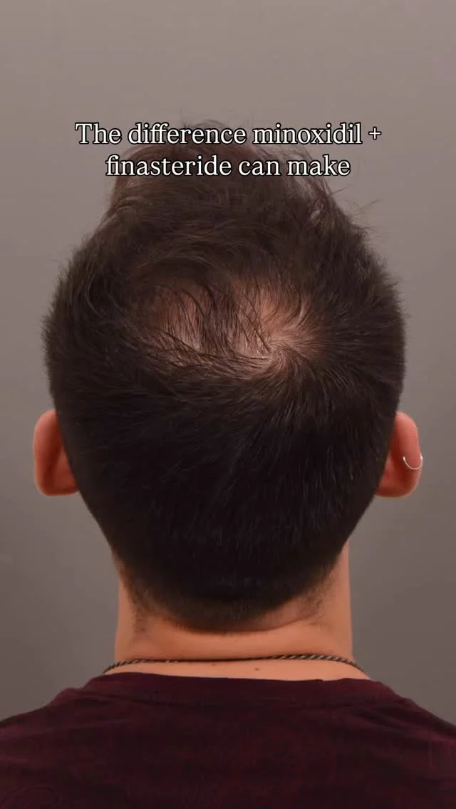 Look at this crown transformation!

This patient has been using our 82F prescription topical for the past 2 years on his crown and hairline.

82F = minoxidil + finasteride in one topical solution

How it works: 
✓ Minoxidil revitalizes shrunken hair follicles 
✓ Finasteride blocks DHT (the hormone causing hair loss) 
✓ Topical application = targeted treatment with fewer side effects

Why patients choose 82F:
- Custom-compounded prescription
- 2 FDA-approved ingredients in one
- Convenient daily application
- Perfect for pre- and post-transplant care

Ready to start your hair restoration journey? Schedule your consultation today! 

#minoxidil #finasteride #dht #hairloss #thinninghair #baldinghair #82f