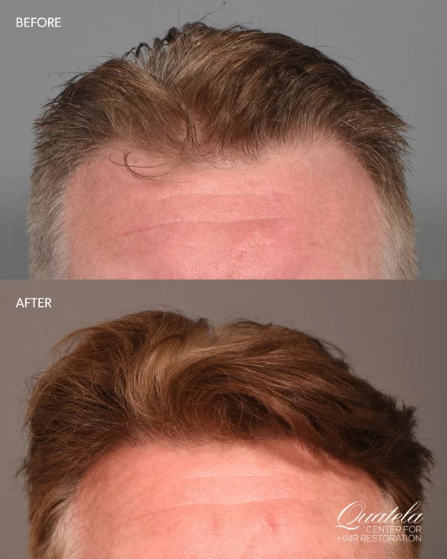 Before & After: 2 Years Post-FUE Hair Transplant

This patient came to us concerned about early-stage thinning around his frontal hairline - and look at these incredible results! 

The full treatment plan: 
* 1,900 grafts transplanted for hairline restoration 
* Started on 82F to prevent further loss 
* Regular PRP sessions for maintenance and growth support 

Early intervention is key. Catch it when it’s just starting to thin and you can get results like this.

#hairtransplantsurgery #fuehairtransplant #fue #minoxidil #finasteride #82F #prp #prptreatment