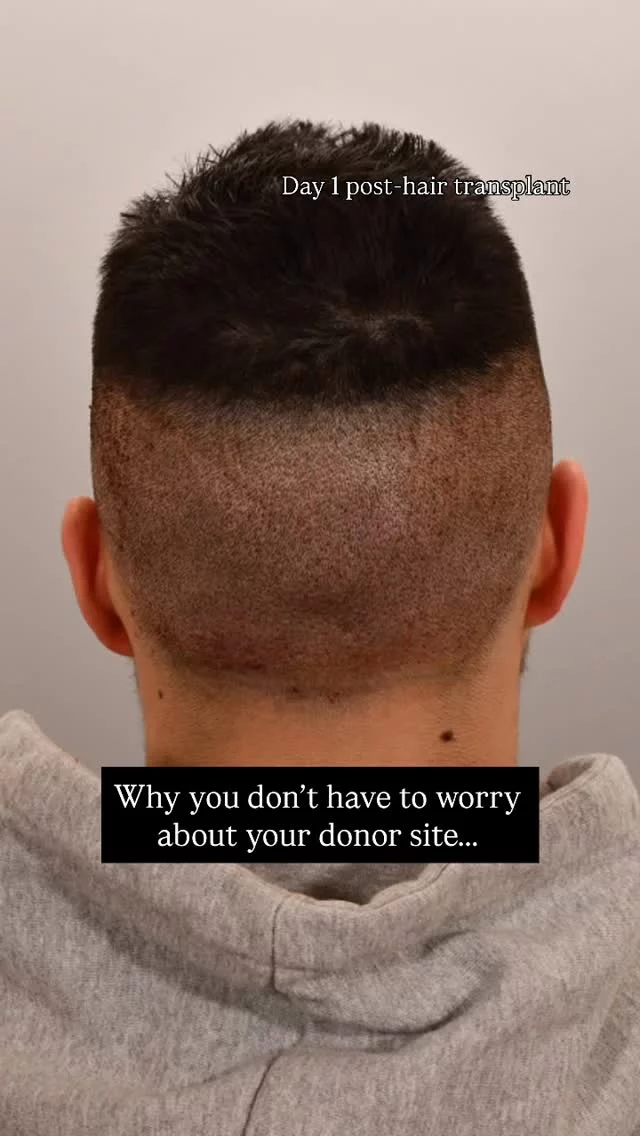 Your donor site heals WAY faster than you think after an FUE transplant!

✅ Day 1: Tiny extraction sites where follicles were removed
✅ Day 14: Fully healed, no visible scarring

You’re back to the gym, work, and social life in no time. No one will even notice!