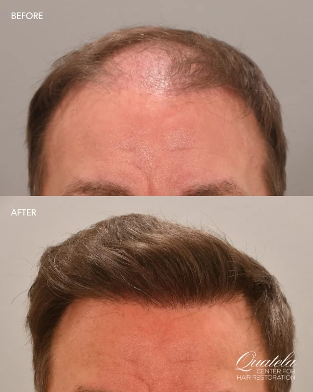 August marks International Hair Loss Awareness Month – a time to recognize that hair loss affects millions and that effective solutions exist. 

At the Quatela Center for Hair Restoration, we’ve been transforming lives for over 30 years with advanced techniques like FUE and FUT hair transplants, PRP therapy, and medical treatments. Whether you’re experiencing early thinning or advanced hair loss, our double board-certified facial plastic surgeon’s create personalized restoration plans that deliver natural-looking results. 

If you’ve been thinking about doing something about your hair loss, now’s a great time to take that first step. Schedule your consultation this month and start feeling like yourself again.

#hairlossawarenessmonth #hairlossawareness #hairlossspecialist #hairrestoration #hairtransplant #prptreatment #minoxidil #finasteride