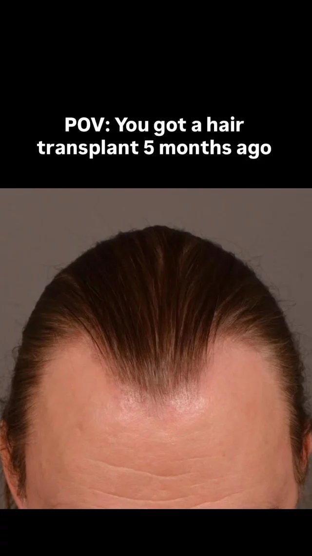 This patient came to us concerned with frontal hairline and temple recession. Now 5 months after his FUT procedure, his temples are already showing incredible progress! 

✨ What you’re seeing: Early results that will continue to dramatically improve over the next 7 months as we approach the 1-year mark - when full results are typically achieved.

At 5 months: New hair is emerging and density is noticeably improving. Hair is still finer than natural hair and some patchiness is normal as follicles grow at different rates. Both donor and recipient areas are well-healed. Remember - full results take up to a year, so patience is key!

Grafts: 3075
Surgeon: Dr. Vito Quatela

#hairtransplantsurgery #hairtransplant #hairrestoration #hairtransplantation #hairloss #hairsurgery