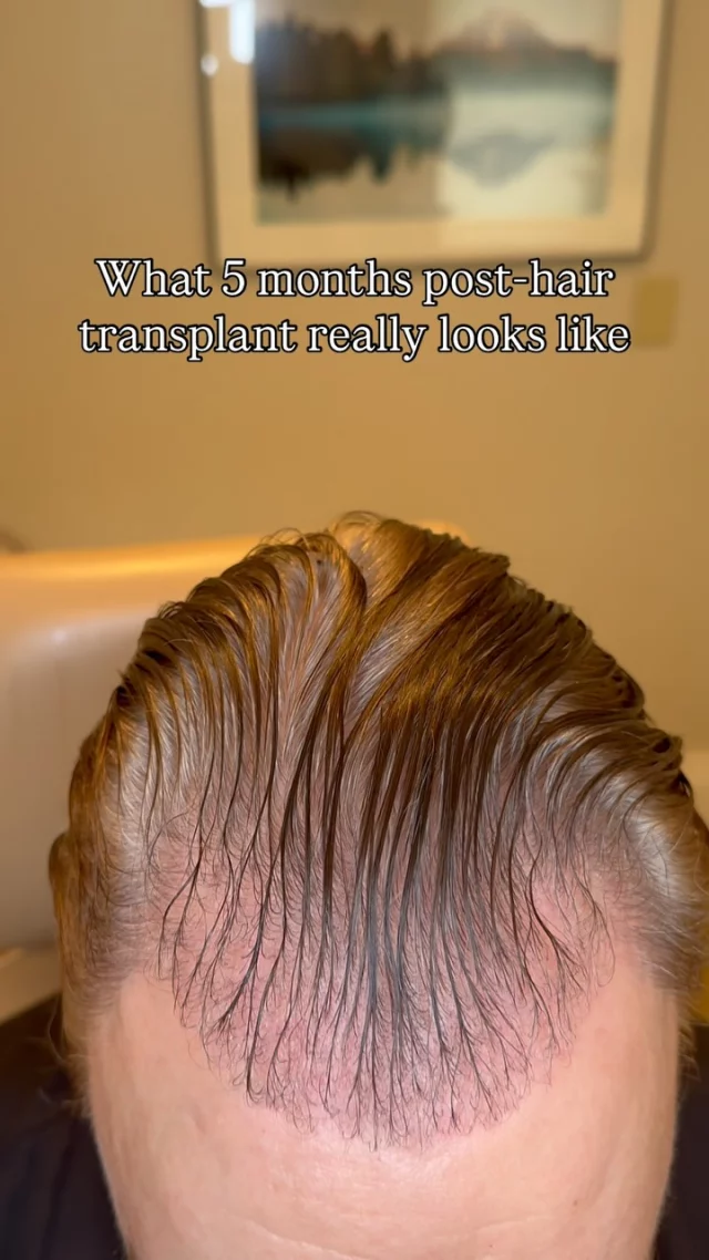 This patient came to us concerned with frontal hairline and temple recession. Now 5 months after his FUT procedure, his temples are already showing incredible progress! 

✨ What you’re seeing: Early results that will continue to dramatically improve over the next 7 months as we approach the 1-year mark - when full results are typically achieved.

At 5 months: New hair is emerging and density is noticeably improving. Hair is still finer than natural hair and some patchiness is normal as follicles grow at different rates. Both donor and recipient areas are well-healed. Remember - full results take up to a year, so patience is key!

Grafts: 3075
Surgeon: Dr. Vito Quatela

#hairtransplantsurgery #hairtransplant #hairrestoration #hairtransplantation #hairloss #hairsurgery