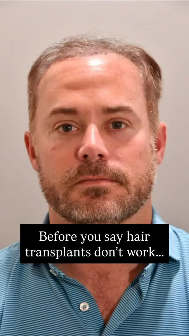 Ever wonder what a hair transplant + PRP can really do? Check this out!

After 2 years of thinning at the hairline, this patient’s FUT transplant + maintenance PRP treatments gave him a full, thick hairline and a serious confidence boost.

Over a year later, the results speak for themselves!

Grafts: 1,900
Surgeon: World-Renowned, Double Board-Certified Facial Plastic Surgeon, Dr. Vito Quatela

#hairtransplantsurgery #hairtransplant #prp #prptreatment #hairlosstreatment #hairrestoration
