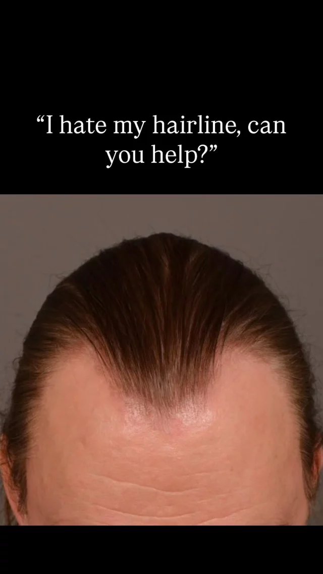 This patient came to us concerned with frontal hairline and temple recession. Now 5 months after his FUT procedure, his temples are already showing incredible progress! 

✨ What you’re seeing: Early results that will continue to dramatically improve over the next 7 months as we approach the 1-year mark - when full results are typically achieved.

At 5 months: New hair is emerging and density is noticeably improving. Hair is still finer than natural hair and some patchiness is normal as follicles grow at different rates. Both donor and recipient areas are well-healed. Remember - full results take up to a year, so patience is key!

Grafts: 3075
Surgeon: Dr. Vito Quatela

#hairtransplantsurgery #hairtransplant #hairrestoration #hairtransplantation #hairloss #hairsurgery