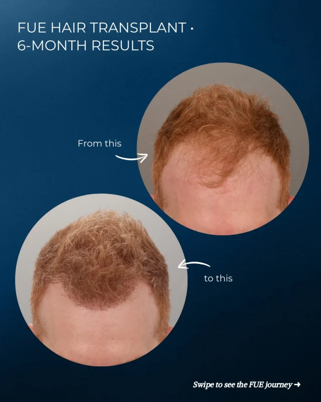 6 months in. Halfway to final results.

After 8 years of progressive thinning, this patient was ready to do something about his hairline. Dr. Lee transplanted 1,900 grafts to his temples and frontal area using FUE.

This is what 6 months of growth looks like—and we’re not even done yet. Full results take a year as the grafts continue to mature and fill in.

Stay tuned for his 1-year update!

Thinking about a transplant? Comment “HAIR” below and we will reach out to you!