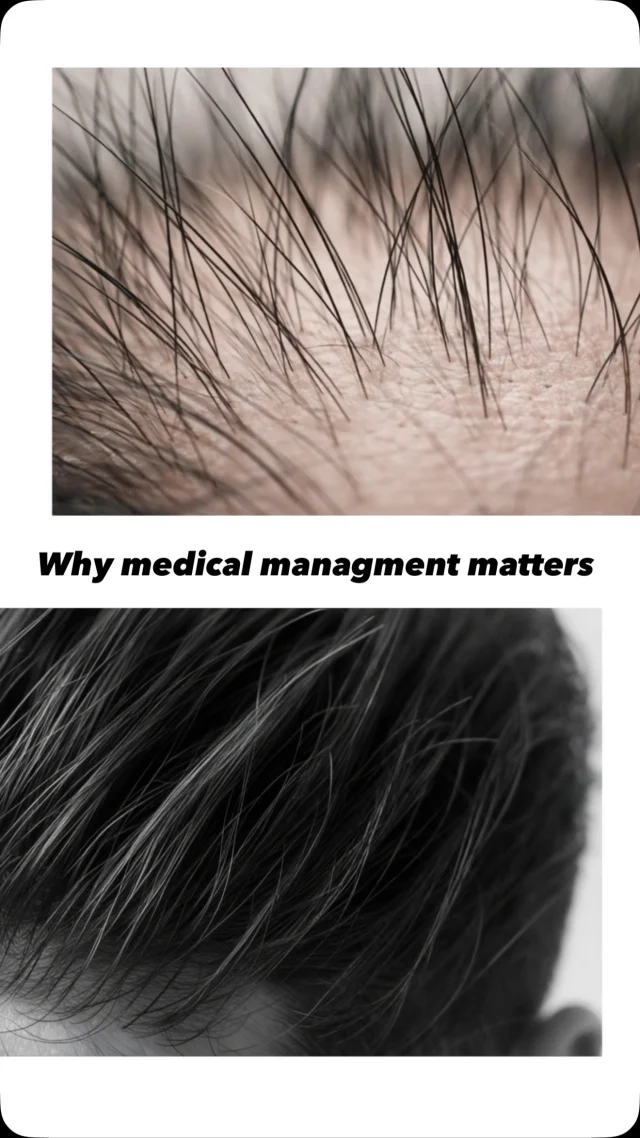 The best hair transplant results don’t start on procedure day—they start months before.

Before your transplant, medications like minoxidil, finasteride, and 82f strengthen your existing hair, reduce the number of grafts needed, and set you up for results that last.

After your procedure? These same therapies protect your native hair while your transplanted follicles thrive.

We typically recommend starting 3-6 months before your procedure, but even a month makes a meaningful difference. Our team will create a personalized protocol based on your hair loss pattern, genetic testing results, and goals.

Your transplanted hair is permanent. Your commitment to maintenance keeps everything else intact.

💬 Comment RESTORE to schedule your consultation with our specialized hair restoration team.​​​​​​​​​​​​​​​​