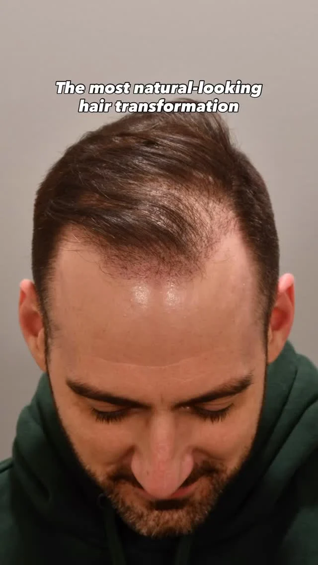 If you have to ask, “Did he have work done?” We did it right.

This hairline restoration was designed to look undetectable: no harsh edges, no over-density, no giveaways. Just a natural hairline that fits his face and age perfectly.

Dr. Lee approaches every transplant as both a surgeon and an artist, understanding where density should build, soften, and blend for results that don’t look “done.”

Technique: Scarless/FUE
Grafts: 2,000
Surgeon: Dr. Heather Lee, Double Board-Certified Facial Plastic Surgeon