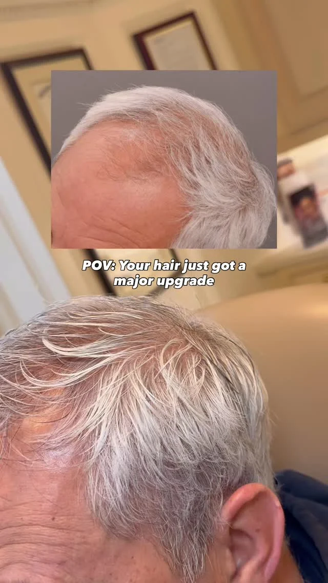There’s a moment when hair loss stops feeling like something you can ignore.

For this patient, that moment turned into action — and two years later, this is where he is.

2,500 grafts placed using the FUT technique, paired with consistent use of 82F to protect his results and his native hair along the way. The hairline you’re looking at didn’t happen by accident. It’s the result of a surgical plan built around his face, his goals, and his long-term picture.

That’s what we do differently here. It’s not just about the day of the procedure — it’s about setting you up so that two years from now, you’re looking at something that genuinely changes how you feel when you look in the mirror.

This is what that looks like.

Surgeon: @dralexmontague 

Comment TRANSPLANT below and we’ll send you all the details on how to get started. 👇
