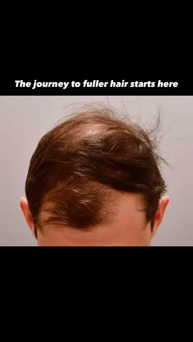 Watching confidence get restored in real time. 🎥

This patient came to us with thinning along his frontal hairline and crown — and we got to work. 1,900 precisely placed grafts later, we’re only two weeks out and already excited for what’s ahead.

FUE (follicular unit transplant) is minimally invasive, which means no linear scar and a faster return to normal life. It unfolds over the next 12 months as those grafts settle in and grow.

Results take time — and they’re worth every week of the wait.

Grafts: 1,900
Surgeon: @dralexmontague