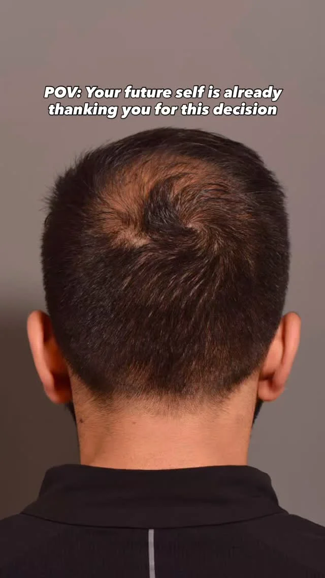 For three years, he watched his hairline change. Then he decided to do something about it.

He sat down with @vitoquatelamd, they talked through his goals, and walked away with a plan — 1,800 graft follicular unit hair transplant (no linear scar), designed around his face and what he wanted to see in the mirror.

He’s early in the journey right now. Hair restoration isn’t overnight — most patients start seeing growth around five months, with the full result filling in closer to the one-year mark. But three years of waiting to take the first step, and now he’s on the other side of it. That part already feels different.

Can’t wait to share his results!

Comment TRANSPLANT below for more info 👇​​​​​​​​​​​​​​​​