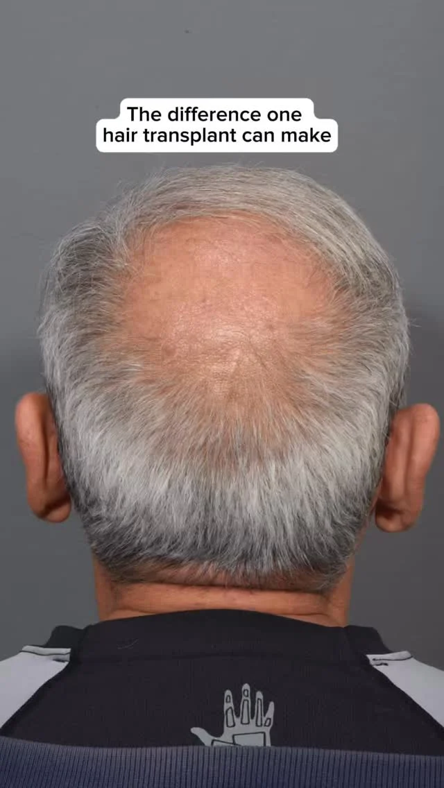 2,000 grafts transplanted. A strong donor site still in reserve. And a year later, this is where he landed.

This patient chose Dr. Quatela for his FUT transplant — and the kind of result that comes from surgical precision meeting an artistic eye doesn’t happen by accident. The best part? He’s got plenty donor hair left to work with if he ever wants to take it further.

Been thinking about making a change? Comment TRANSPLANT below and we’ll send you everything you need to know.