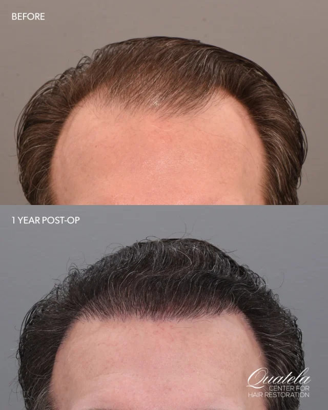 This is what a year of growth looks like.

What we love most about this transformation is how natural it looks. The hairline is soft, undetectable — no telltale signs, no harsh lines. Just hair that frames his face the way it should.

Hair restoration is as much an art as it is a procedure, and this is exactly what that looks like in practice.

Surgeon: @vitoquatelamd 
Technique: Follicular Unit Transplant