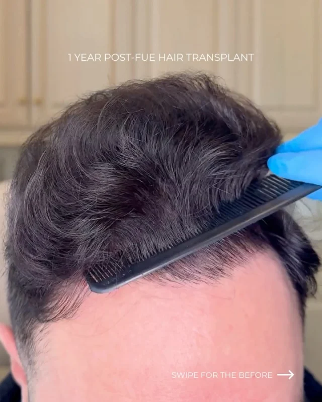 The best sign a hair transplant worked? The patient books another one.

One year post-FUE with Dr. Quatela, 1,100 grafts in — and the results already look incredible. He’s coming back for a second procedure simply because he wants even more density. When something works this well, why stop?

We always recommend waiting a full year before considering a second transplant. That’s when you’re seeing the complete picture — full growth, final density, the whole result. Once you know exactly what you’re working with, we can build on it strategically and get you even more of what you want.

That’s exactly what we’re doing here.

Comment RESTORE to schedule your consultation.