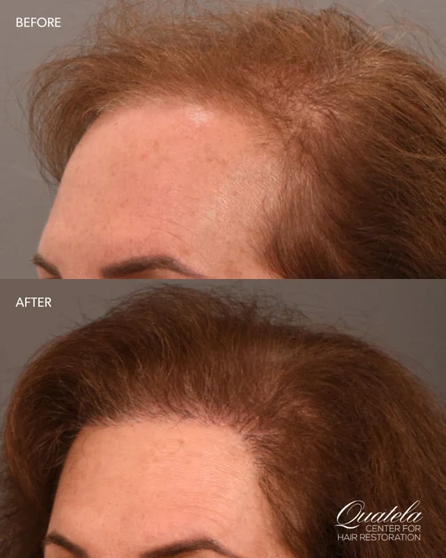 “My hairdresser of 30 years can’t believe how much hair I have!”

ONE YEAR LATER. This is her full result.

She came to us thinking she wanted a forehead lowering procedure — and instead chose a hair transplant with @dralexmontague to restore her hairline and naturally bring it forward. Look at where her hairline sits now. The change is everything.

We’ve also been doing PRP injections throughout the year to make sure every single hair came in as thick and strong as possible. 

This is what a full plan looks like at 12 months. We are obsessed with her result.

Comment RESTORE to schedule your consultation.